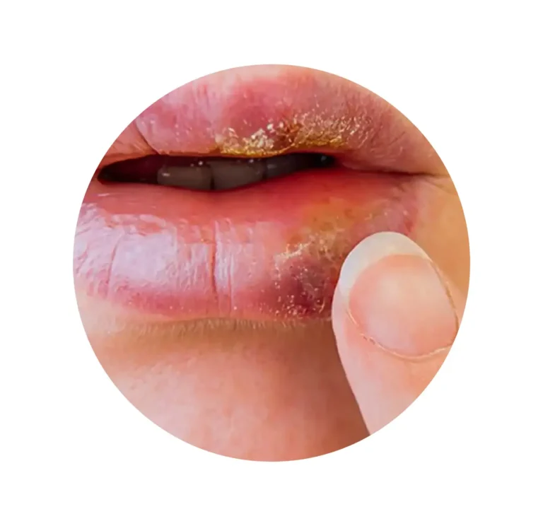 ENFERMEDADES VENEREAS-05