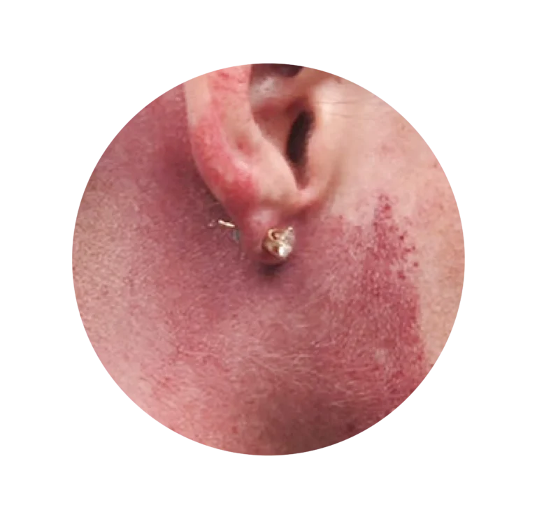 LESIONES VASCULARES-06