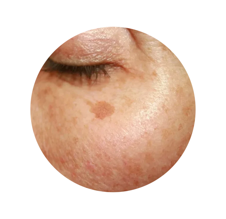 MANCHAS EN LA PIEL-06