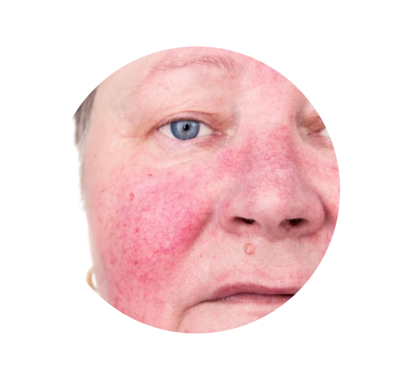 ROSACEA-05