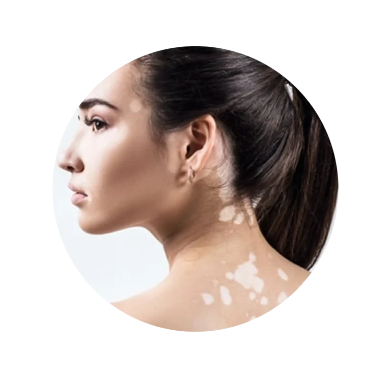 vitiligo-05